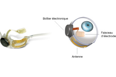 Implant Second Sight