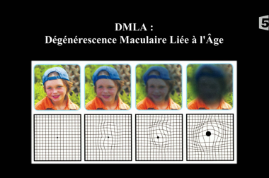 Visage qui devient sombre et lignes qui se courbent, les signes de la DMLA