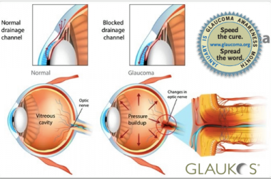 Shéma de l'oeil avec implant